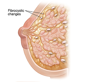 Cross section of breast showing fibrocystic changes.